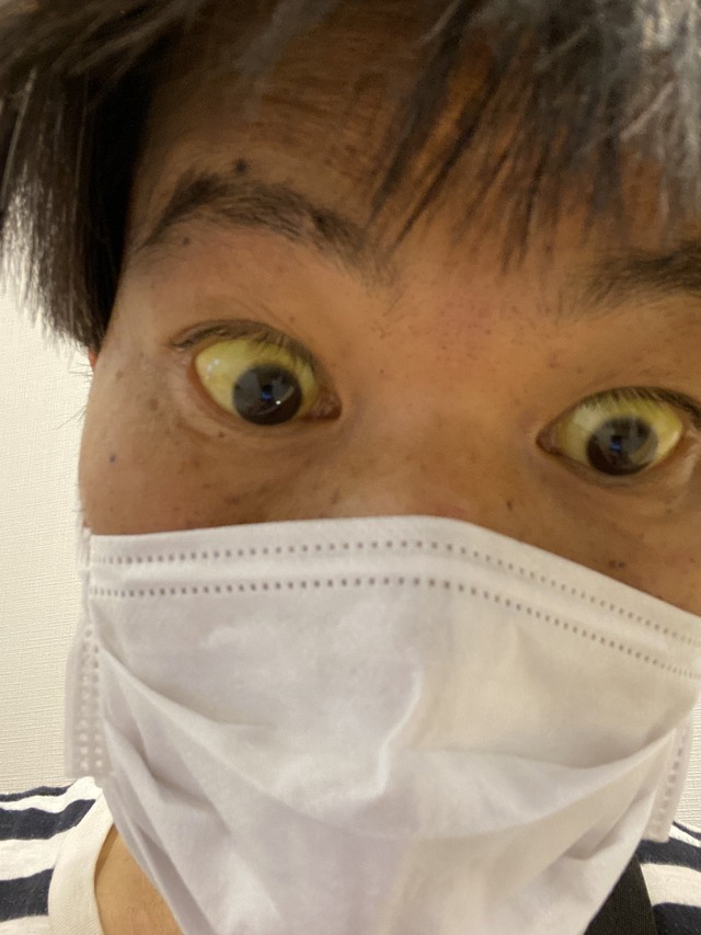 配信者・金バエが救急搬送される 医師は「1年後には死んじゃうよ」と宣告
