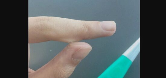 皮膚についた瞬間接着剤、対処に注意　特にティッシュで拭くとヤバいことになるぞ・・・