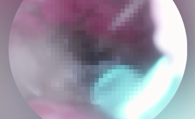 耳からクモを取り出すも痛みが続いていた女性が病院へ行く → 医者からヤバイ事実を告げられる・・・