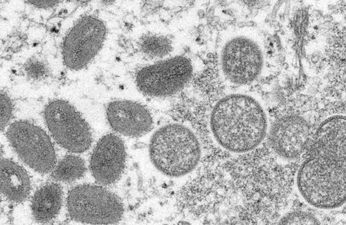 エムポックス(サル痘)で国内初の死者　海外渡航歴のない埼玉県の30代男性が死亡