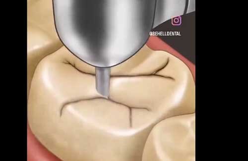 虫歯治療って実際は何やってるの？ がよくわかる動画！！ 早めに行かないとダメな理由もまるわかり