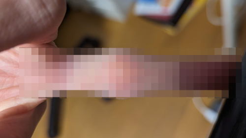 X民「指の関節鳴らすの気持ちいい～！！」ﾎﾟｷﾎﾟｷ→6年後、マジでとんもないことにｗｗｗｗｗネット民「え、きも」医師「◯◯というレアな疾患ですね」