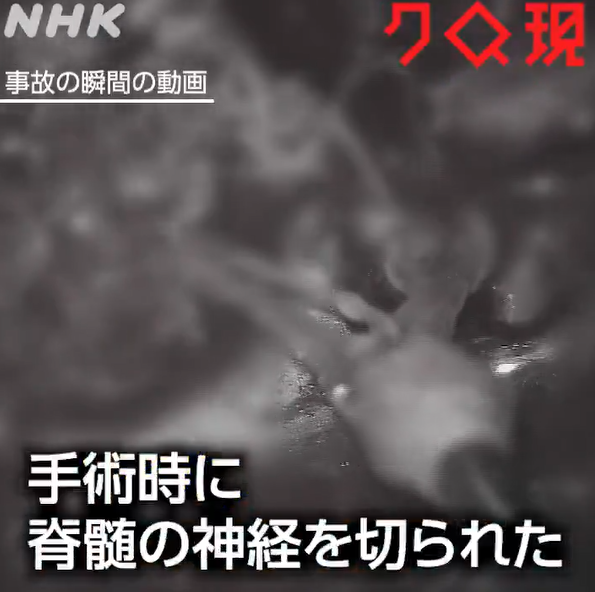 NHKさん、「脳外科医 竹田くん」が神経をドリルでスパゲティしてプチプチする映像を流してしまう
