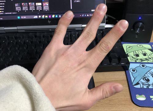 両手の指が欠損している男性「これは中指が足りてない判定らしい」ネット民「中指立てたい時どうするの？」→結果ｗｗｗｗｗ