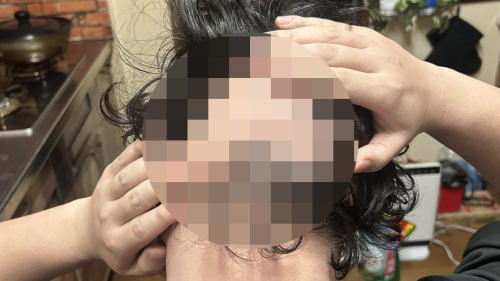 【悲報】高校3年生「18歳なのにハゲてきた　助けて・・・皮膚科で治療したけど生えてこないの！」ﾊﾟｼｬｯ→投稿された画像がエグすぎる