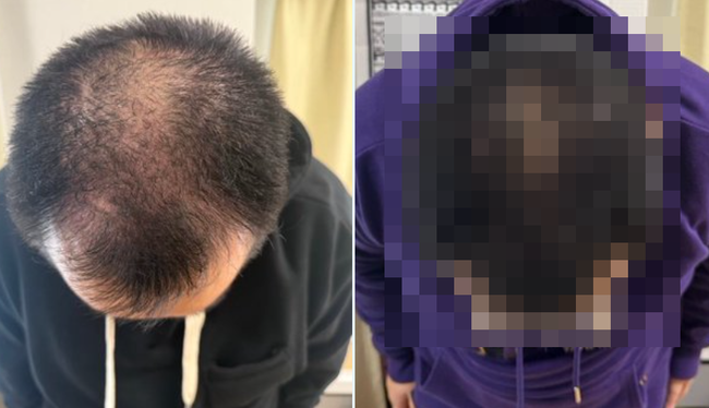 ハゲてる男性「薬局で発毛剤を買ったけど本当に効果あるんかな？試してみるわ」 → 3ヵ月後、凄いことになるｗｗｗｗｗ