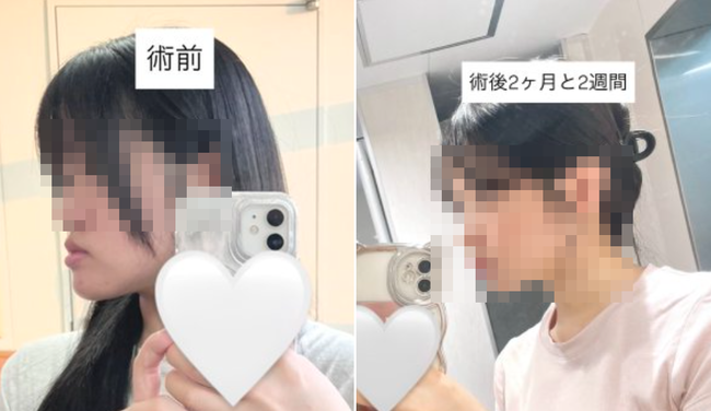 女子「顎が飛び出てるから整形してくるわ」 → めっちゃ可愛くなり話題に！！「本当に可愛い」「赤ちゃんみたい」