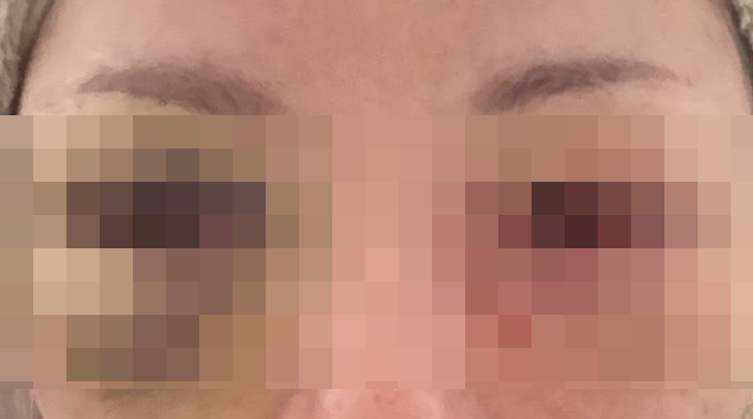 女性「目の下のクマ気になるから手術して取ってもらおｗ」→取り返しのつかない最悪の事態に・・・